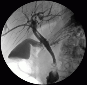 PTC: Der Gallengangskatheter kommt von rechts (linker Bildrand) und liegt mit einer Schlaufe vor der Tumorstenose des Gallengangs.